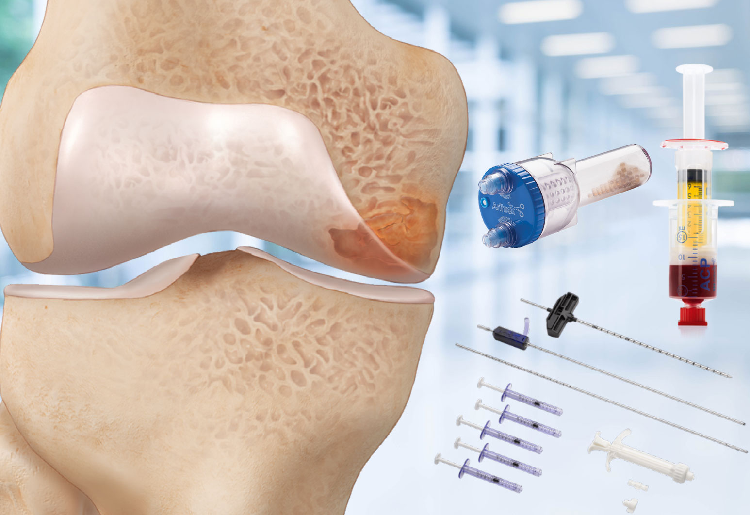 biomendix-intraosseoz-bioplasty-iobp-teknigi